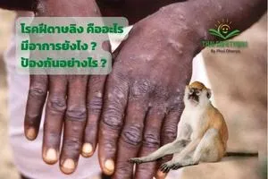โรคฝีดาษลิง หรือฝีดาษวานร คืออะไร มีอาการยังไง และป้องกันอย่างไร