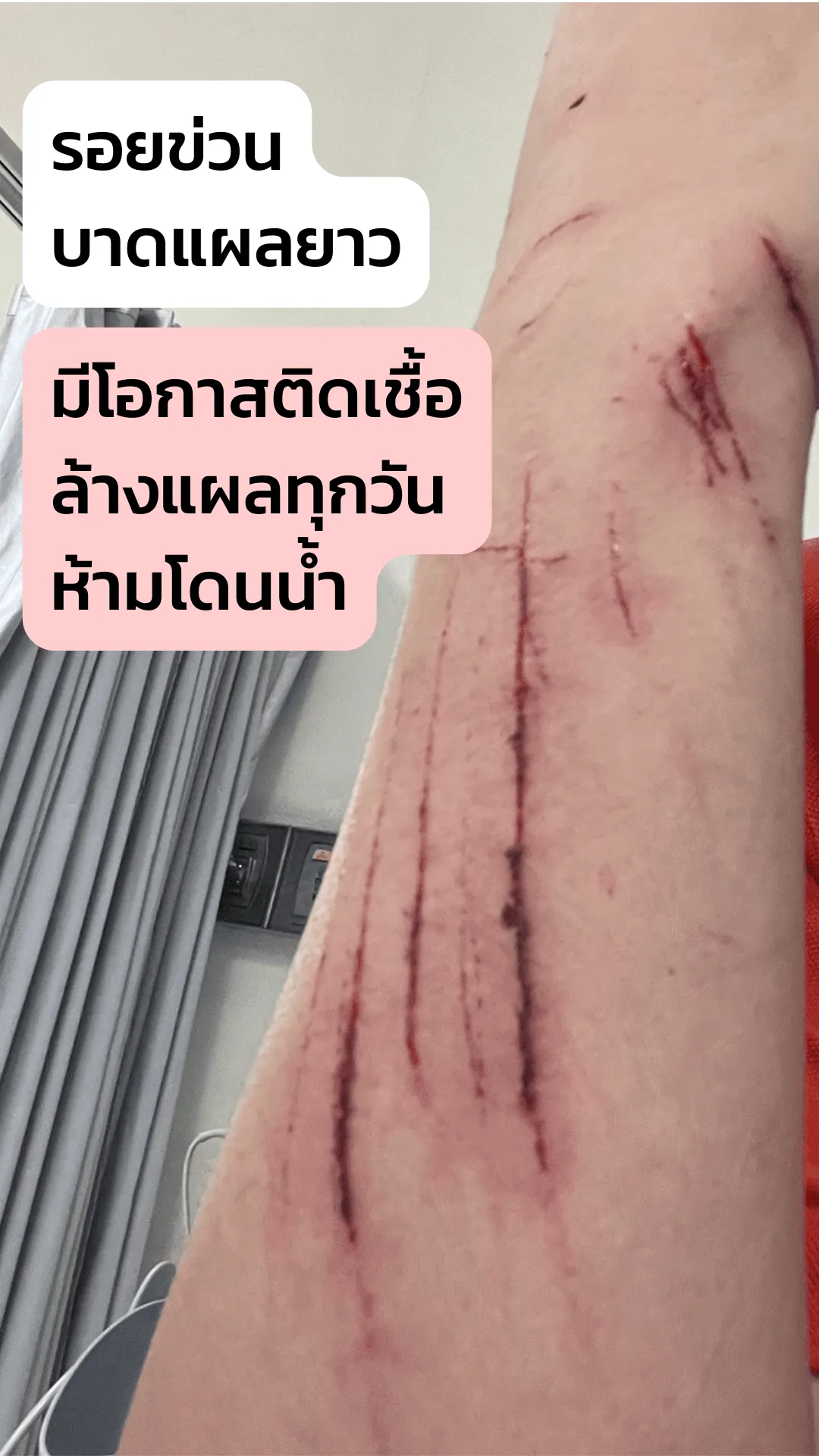 บาดแผล ที่ถูกแมวกัด แมวข่วน อันตรายกว่าที่คุณคิด