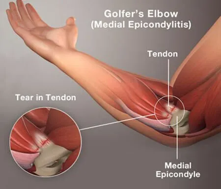 เอ็นกล้ามเนื้ออักเสบบริเวณข้อศอก (Tennis elbow, Golfer elbow)