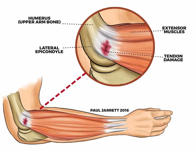 เอ็นกล้ามเนื้ออักเสบบริเวณข้อศอก (Tennis elbow, Golfer elbow)