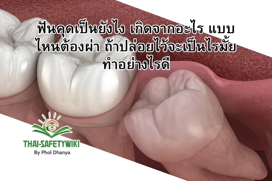ฟันคุดเป็นยังไง เกิดจากอะไร แบบไหนต้องผ่า ถ้าปล่อยไว้จะเป็นไรมั้ย