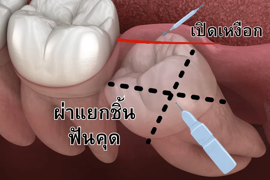 ฟันคุดเป็นยังไง เกิดจากอะไร แบบไหนต้องผ่า ถ้าปล่อยไว้จะเป็นไรมั้ย