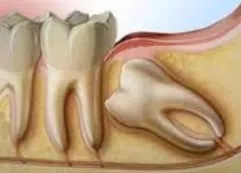 ฟันคุดเป็นยังไง เกิดจากอะไร แบบไหนต้องผ่า ถ้าปล่อยไว้จะเป็นไรมั้ย