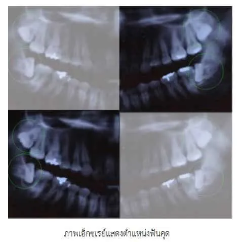 ฟันคุดเป็นยังไง เกิดจากอะไร แบบไหนต้องผ่า ถ้าปล่อยไว้จะเป็นไรมั้ย