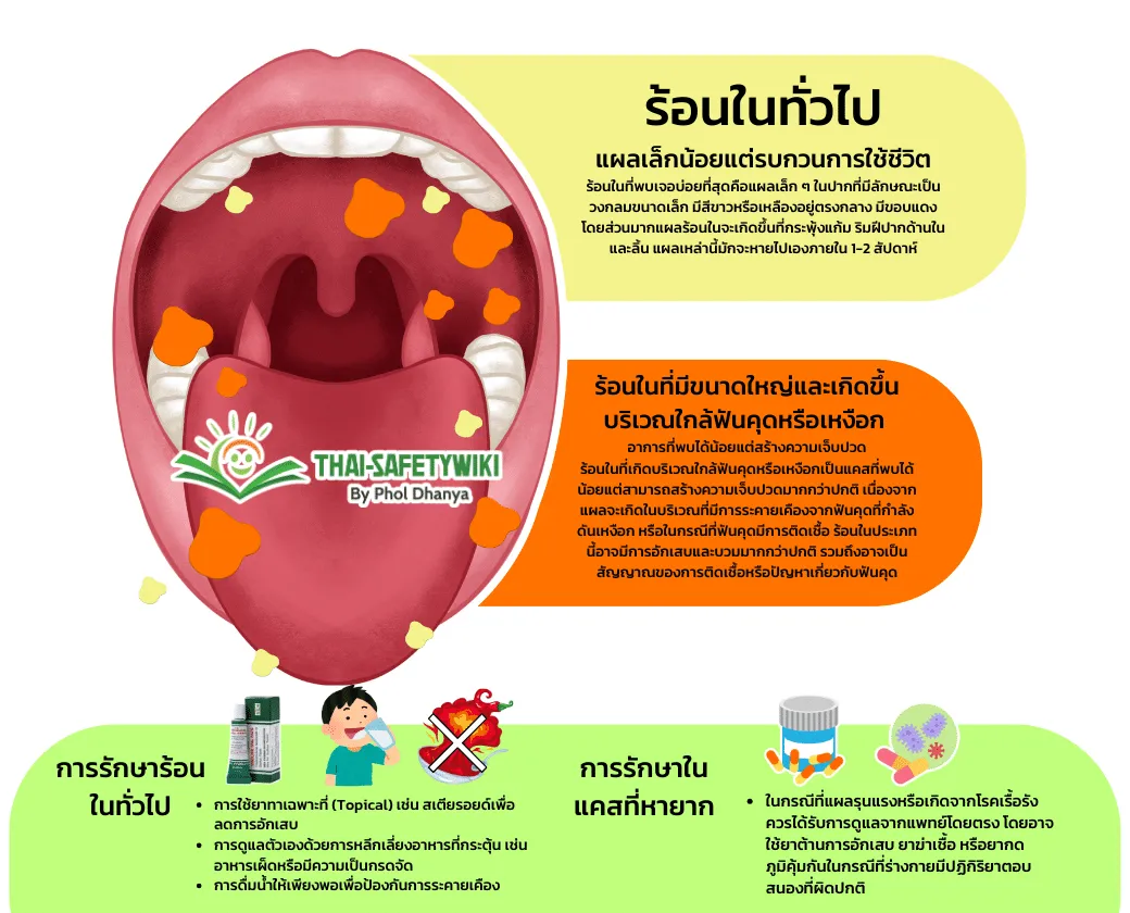 ร้อนใน ปัญหาช่องปากที่พบเจอบ่อยและแคสที่หายาก พร้อมวิธีการรักษาอย่างละเอียด