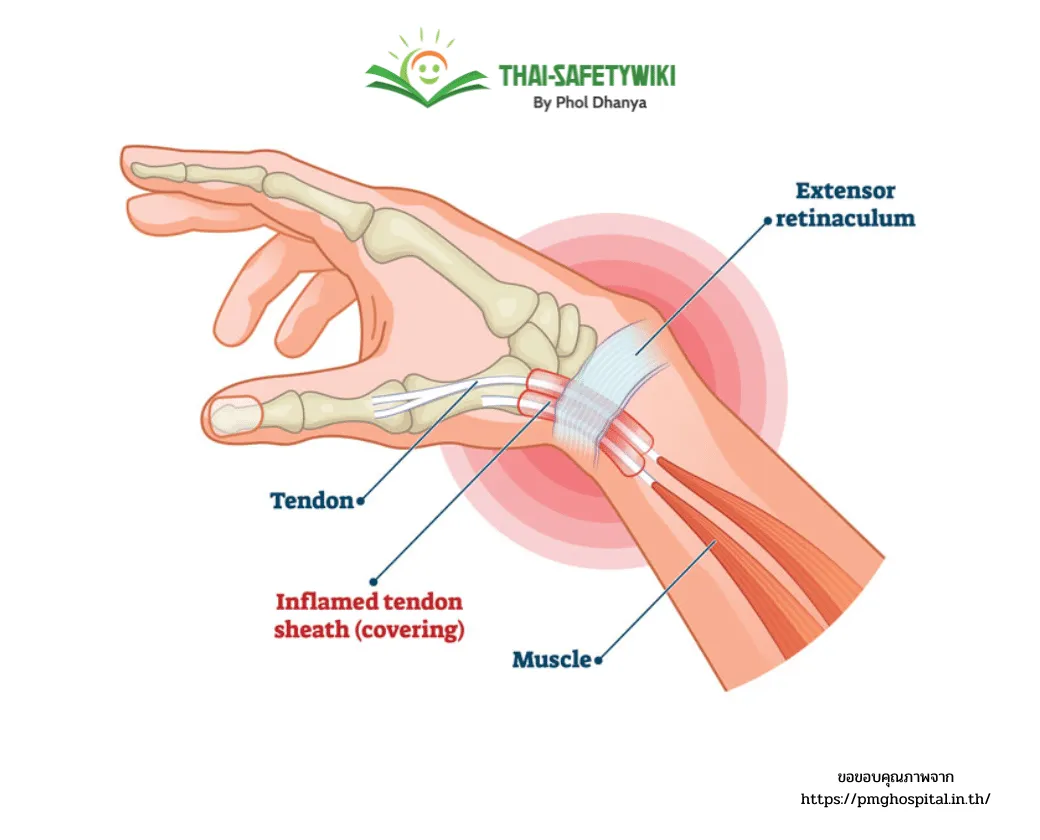 โรค “ปลอกหุ้มเอ็นข้อมืออักเสบ” พบบ่อยมากขึ้นในปัจจุบัน