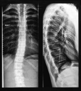 Xray image of spine